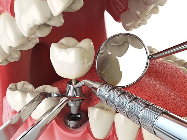 Best Emergency Wisdom Teeth Removal in Lochmoor Waterway Estates, FL